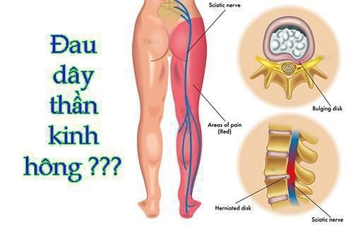 Đau dây thần kinh hông