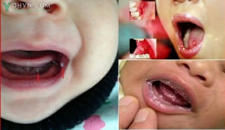 Biện pháp phòng bệnh
