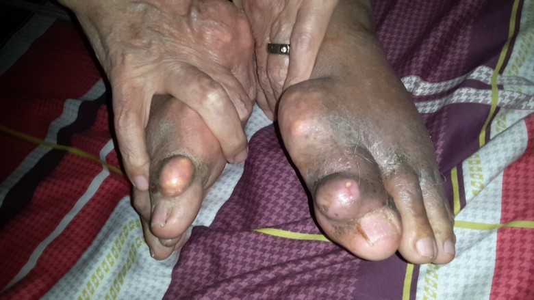 Hình ảnh bệnh nhân gout