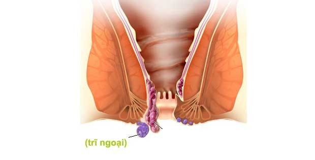 Trĩ ngoại