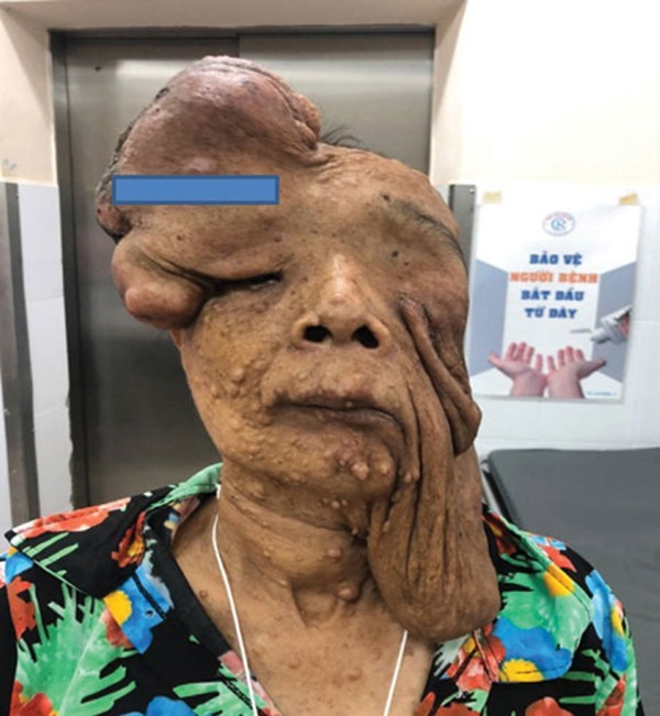 Bệnh lý có tính di truyền