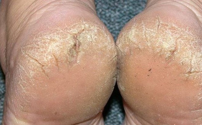 1. Do thói quen ăn uống không đủ chất