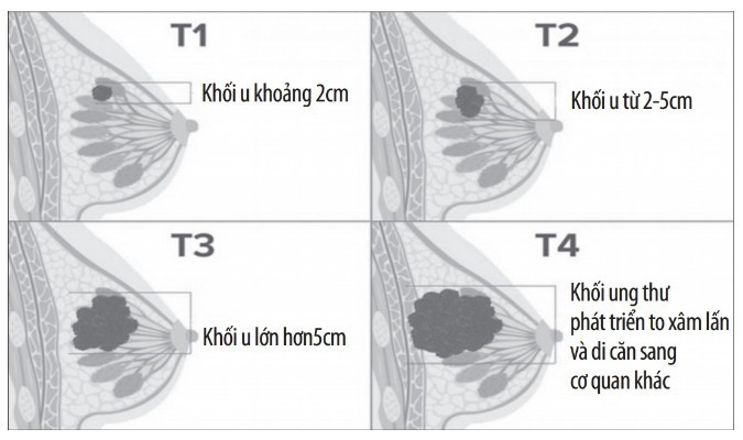 Ung thư vú đứng hàng đầu trong các bệnh ung thư thường gặp ở phụ nữ.