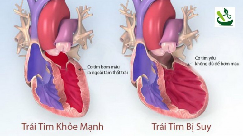 Tham khảo thêm kiến thức bệnh Suy tim