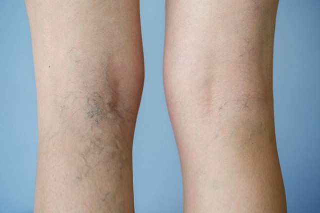 Bài thuốc trị suy giãn tĩnh mạch chân