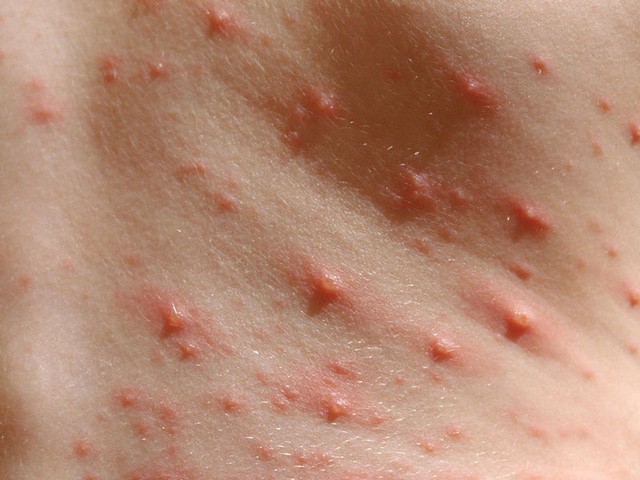 Thủy đậu (dân gian gọi là phỏng dạ) là bệnh truyền nhiễm thường gặp ở cả trẻ em và cả người trưởng thành (nhiều nhất là trẻ em do hệ miễn dịch kém).