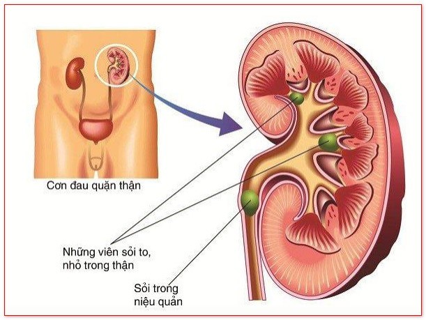 Nguyên nhân gây sỏi tiết niệu?