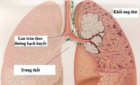 Dấu hiệu ung thư phổi ở tay và vai