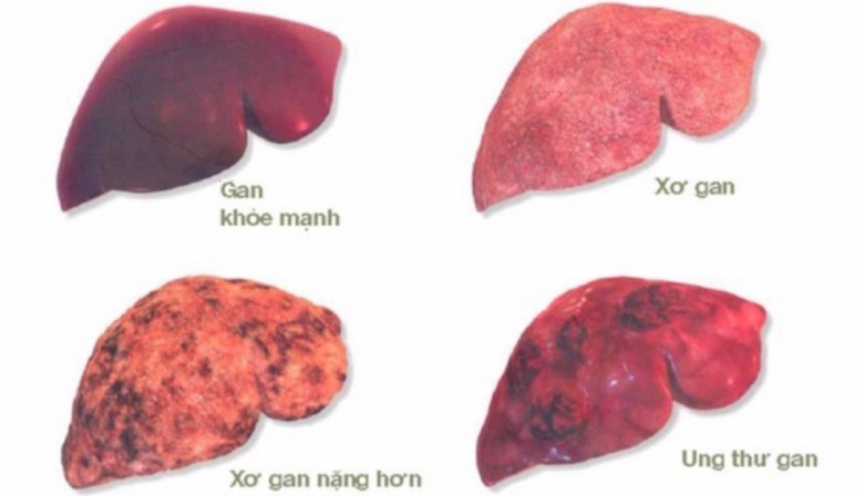 Biến chứng nặng nề