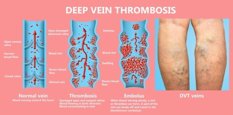 Huyết khối tĩnh mạch sâu (DVT - deep venous thrombosis) là tình trạng bệnh lý xếp thứ 3 trong số bệnh lý tim mạch