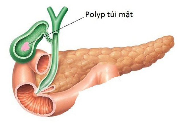2. Polyp túi mật khi nào có nguy cơ cao chuyển thành u ác tính?