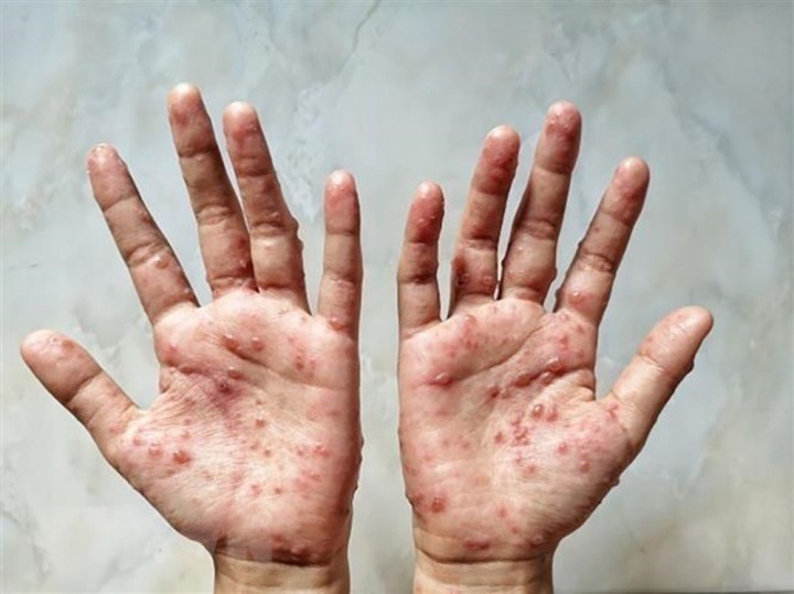 Điều trị đậu mùa khỉ