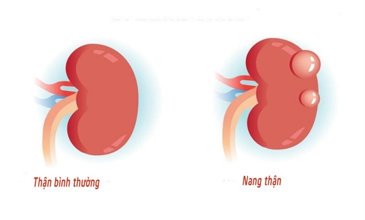 2. Biểu hiện khi bị nang thận