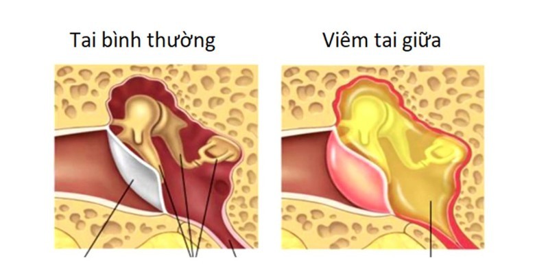 1.2 Đối với thể mạn tính