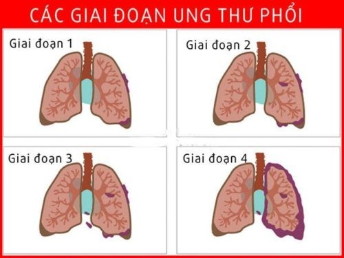 Dưới đây là 7 dấu hiệu cảnh báo ung thư phổi nam giới cần chú ý: