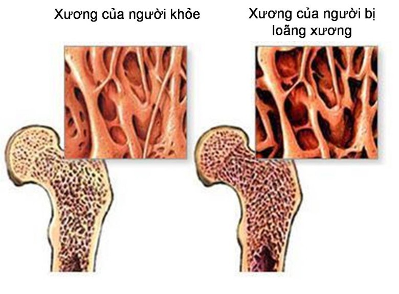 Bệnh loãng xương dưới góc nhìn của Đông y