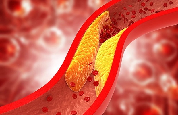 Cholesterol cao là ‘quả bom hẹn giờ’, nếu thấy 3 dấu hiệu này ở mắt thì đừng bỏ qua