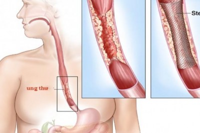 Những bài thuốc nam chữa ung thư thực quản