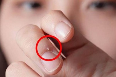 Những bệnh nguy hiểm biểu hiện trên móng, ngón tay thường gặp nhất