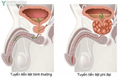 Điều trị phì đại tuyến tiền liệt  thể lành tính theo BS. NGÔ VĂN TUẤN