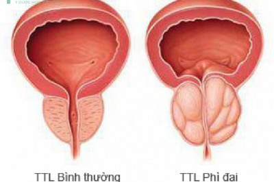 Dấu hiệu nhận biết bệnh phì đại tuyến tiền liệt