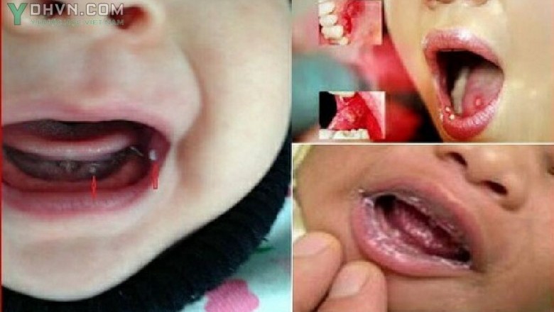 Dấu hiệu nhận biết và điều trị bệnh nấm miệng
