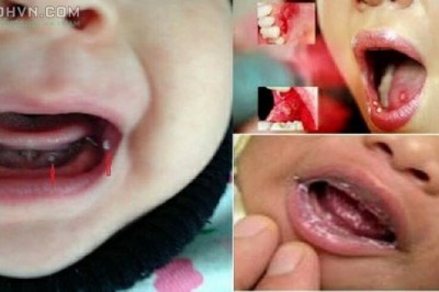 Dấu hiệu nhận biết và điều trị bệnh nấm miệng