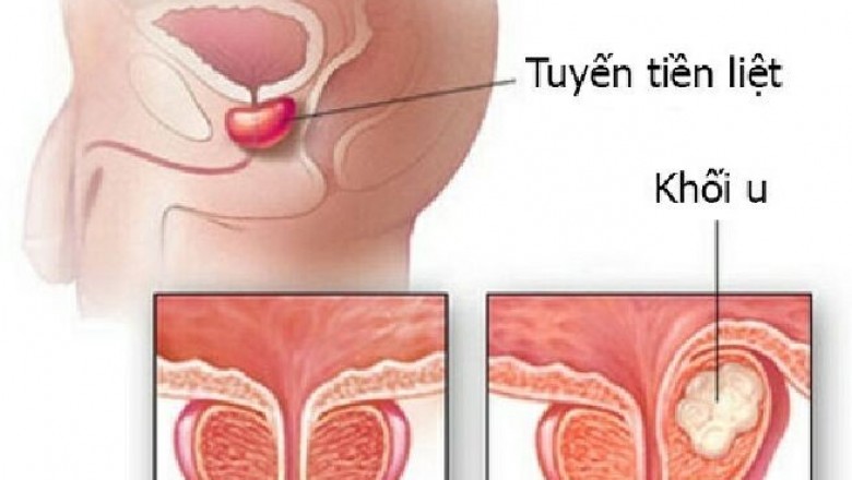 Các giai đoạn của bệnh ung thư tiền liệt tuyến
