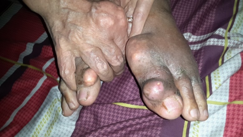 Biến chứng nguy hiểm của bệnh gout ít người biết