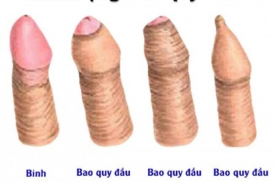 Hẹp bao quy đầu ở bé trai là gì cần điều trị như thế nào?