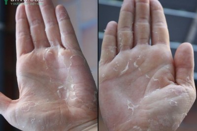 Bong da bàn tay bàn chân là bệnh gì và chữa như thế nào ?