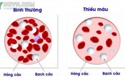 Món ăn bài thuốc từ thảo dược Việt Nam tốt cho người bị thiếu máu