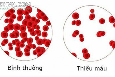 Bệnh thiếu máu: Nguyên nhân, Biểu hiện, Điều trị, Phòng ngừa như thế nào?