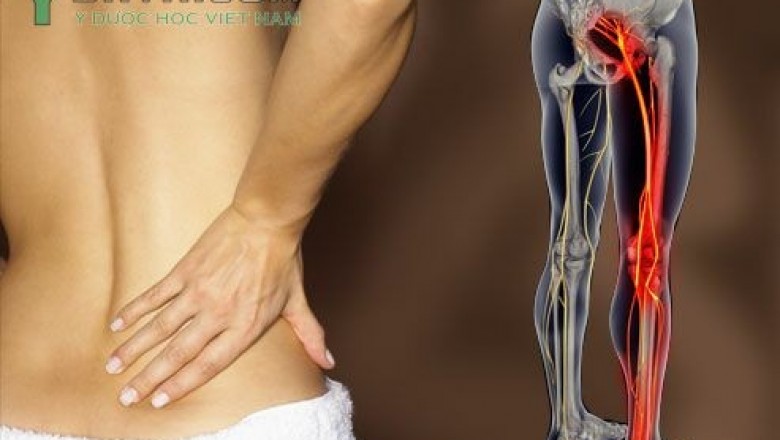 Bài thuốc chữa đau dây thần kinh hông: theo BS. Phạm Đức Dương