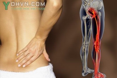 Bài thuốc chữa đau dây thần kinh hông: theo BS. Phạm Đức Dương