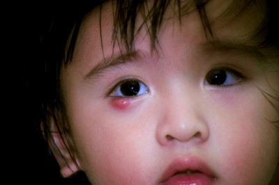 Các bệnh mắt thường gặp ở trẻ và cách điều trị: theo Dược sỹ Như