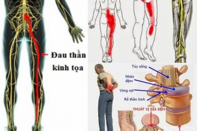 Hỗ trợ trị đau thần kinh tọa, đau dây thần kinh liên sườn theo đông y gia truyền 500 năm