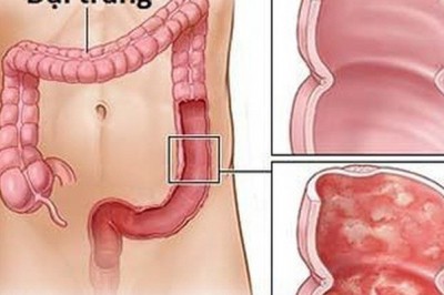 Bài thuốc đông y hay chữa bệnh Viêm đại tràng: theo Lương y Đình Thuấn 