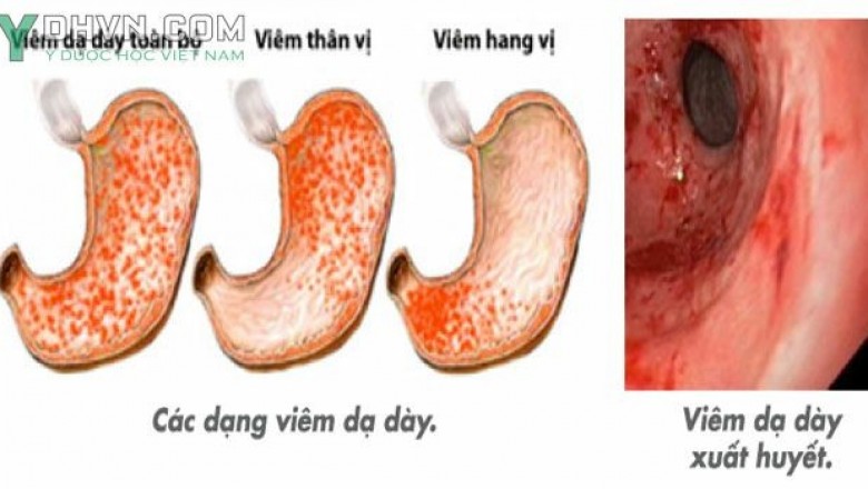 Đông y điều trị viêm loét dạ dày: theo TS. BSCKII. Dương Trọng Nghĩa