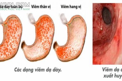 Đông y điều trị viêm loét dạ dày: theo TS. BSCKII. Dương Trọng Nghĩa