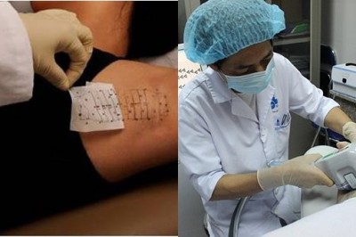 Bác sĩ tiết lộ sự thật những phương pháp điều trị hôi nách hiện nay