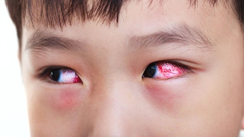 Bệnh đau mắt đỏ: Dấu hiệu và cách chữa hiệu quả nhất