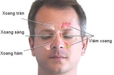 Cách chữa viêm xoang bằng Nam Y