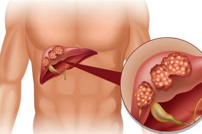 Vì sao ngày càng nhiều người chết do ung thư gan?