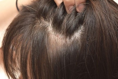 Những thực phẩm ngăn tóc bạc sớm và gãy rụng