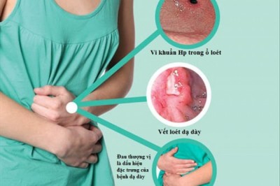 Bệnh viêm dạ dày tá tràng là gì? Nguyên nhân, triệu chứng và cách chữa bệnh viêm dạ dày tá tràng