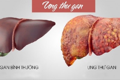 Những dấu hiệu báo động ung thư gan