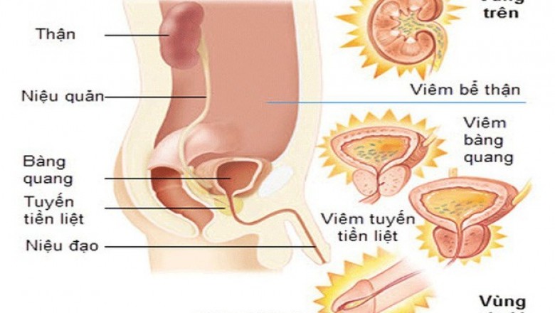 Dấu hiệu của viêm đường tiết niệu ở người lớn và trẻ em