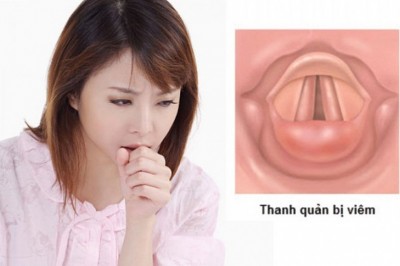 Bài thuốc trị bệnh viêm thanh quản