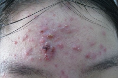 Y học cổ truyền điều trị mụn trứng cá